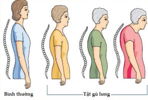 Nguyên nhân gây tình trạng gù lưng