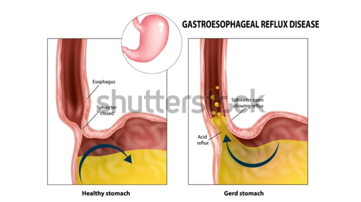 How To Get Rid Of Heartburn